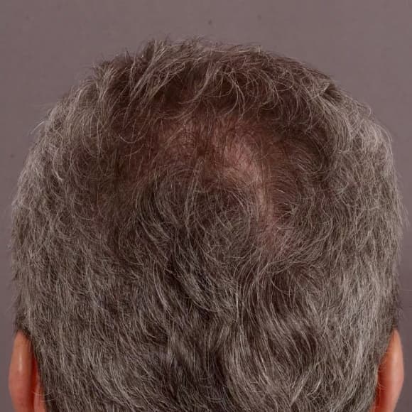 Male Hair Transplant Case #23 After Image