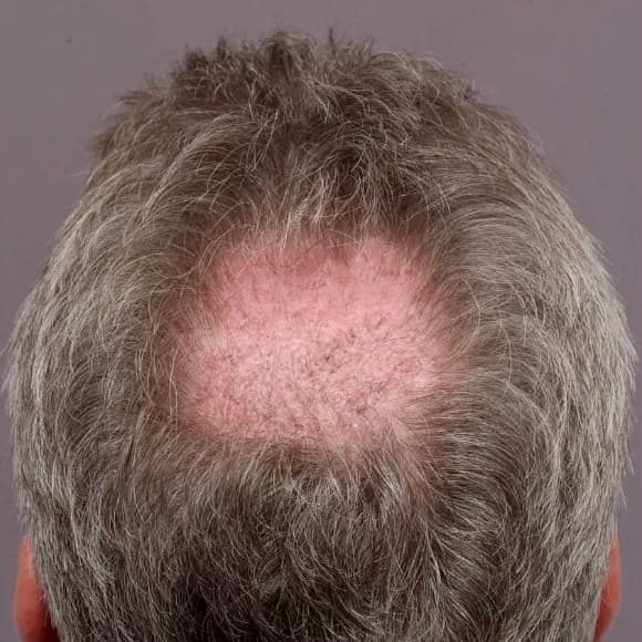 Male Hair Transplant Case #23 Before Image