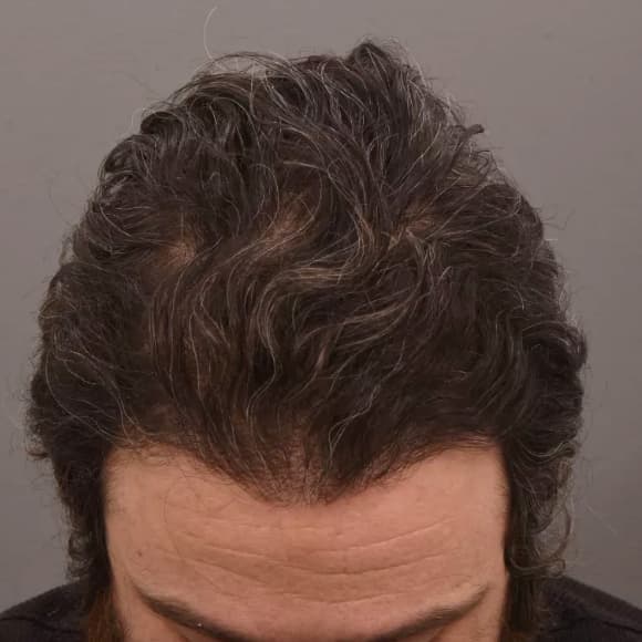 Male Hair Transplant Case #42 After Image