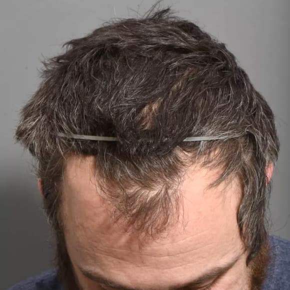 Male Hair Transplant Case #42 Before Image