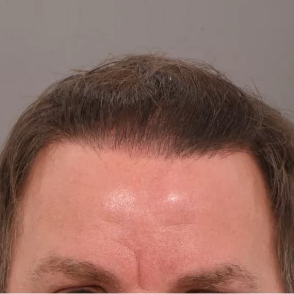 Male Hair Transplant Case #44 After Image