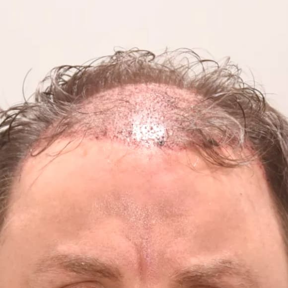 Male Hair Transplant Case #44 Before Image