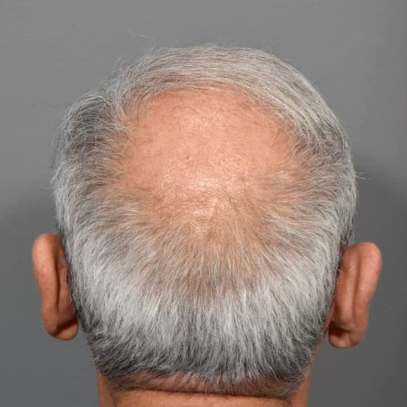 Male Hair Transplant Case #46 Before Image