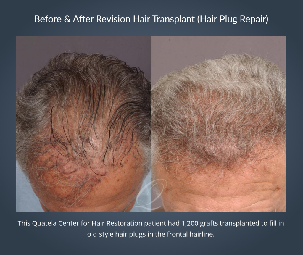 Hair Transplant in Buffalo, NY | Quatela Center for Hair Restoration