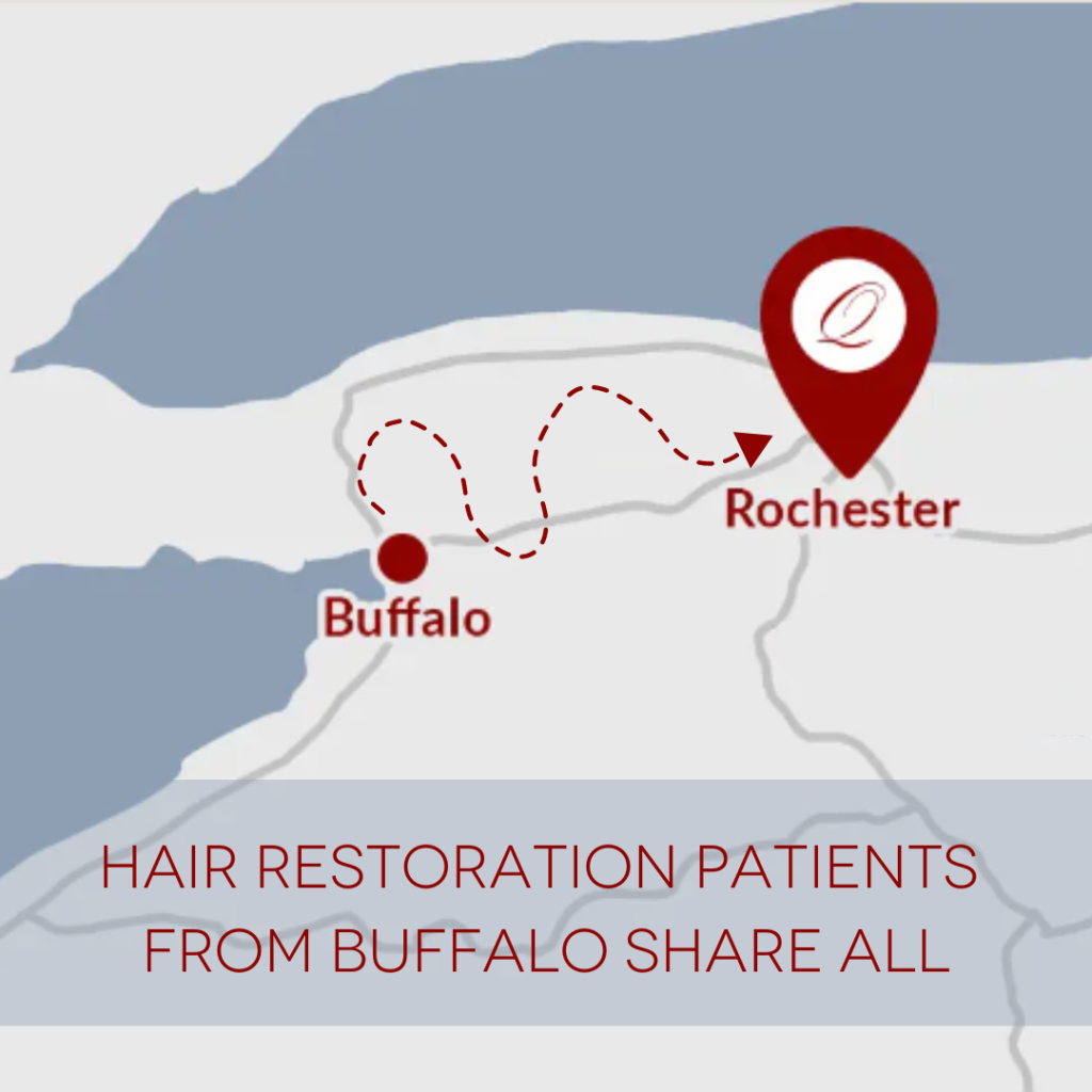 map of Buffalo to Rochester, Hair Restoration Patients From Buffalo Share all