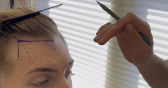 marking a patient's hairline to show where to place hair grafts in a hair transplant