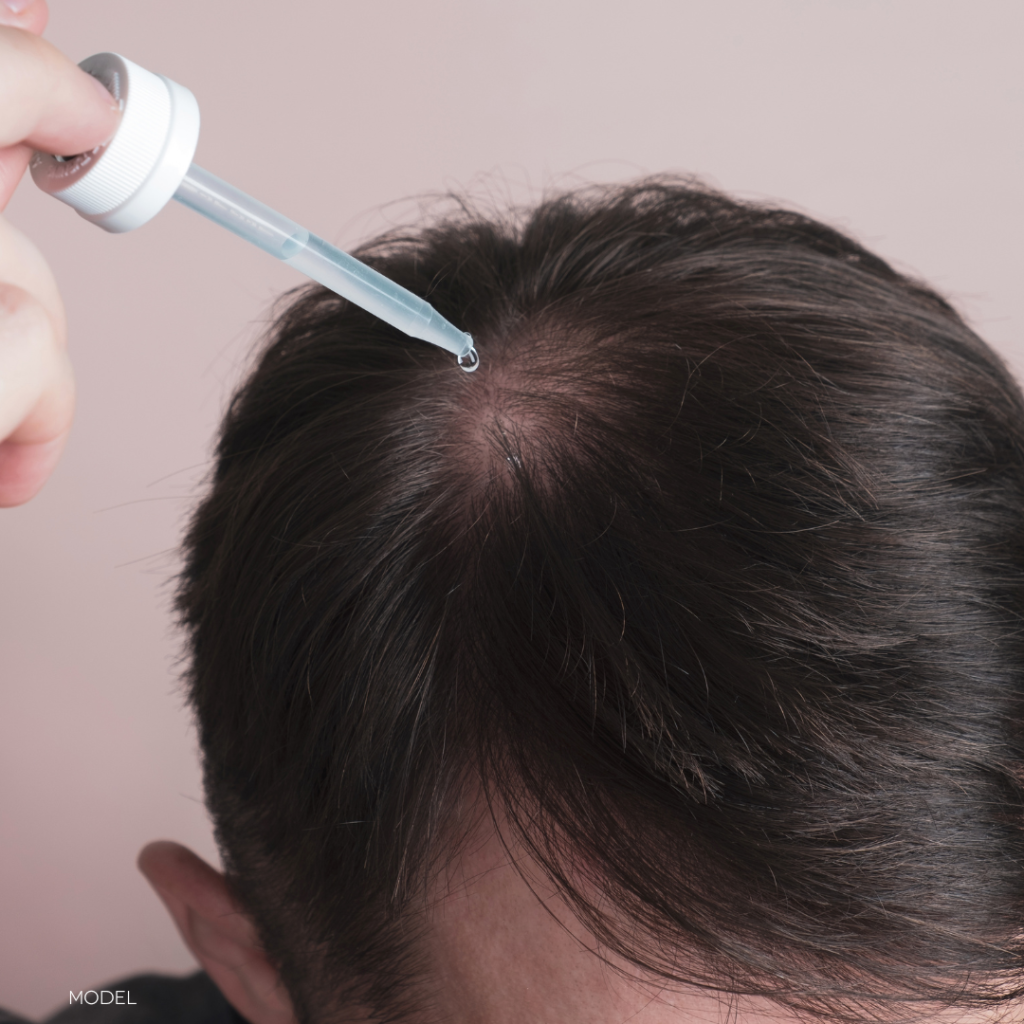 man applying topical solution to thinning area of hair on scalp