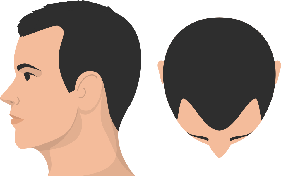 Class 2 Hair Loss graphic