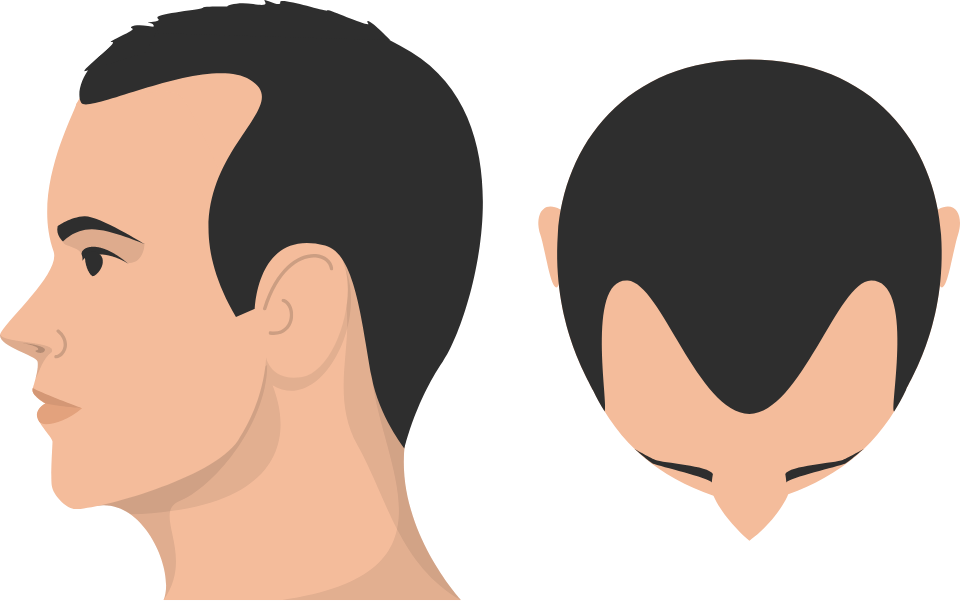 Class 3 Hair Loss graphic