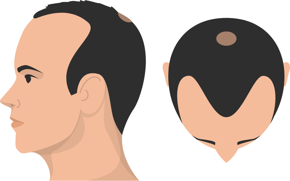 Class 4 Hair Loss graphic