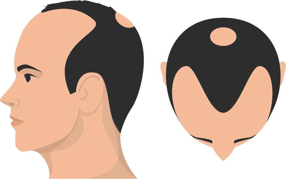 Class 5 Hair Loss graphic