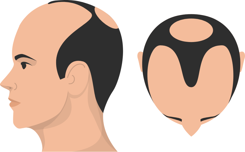 Class 6 Hair Loss graphic