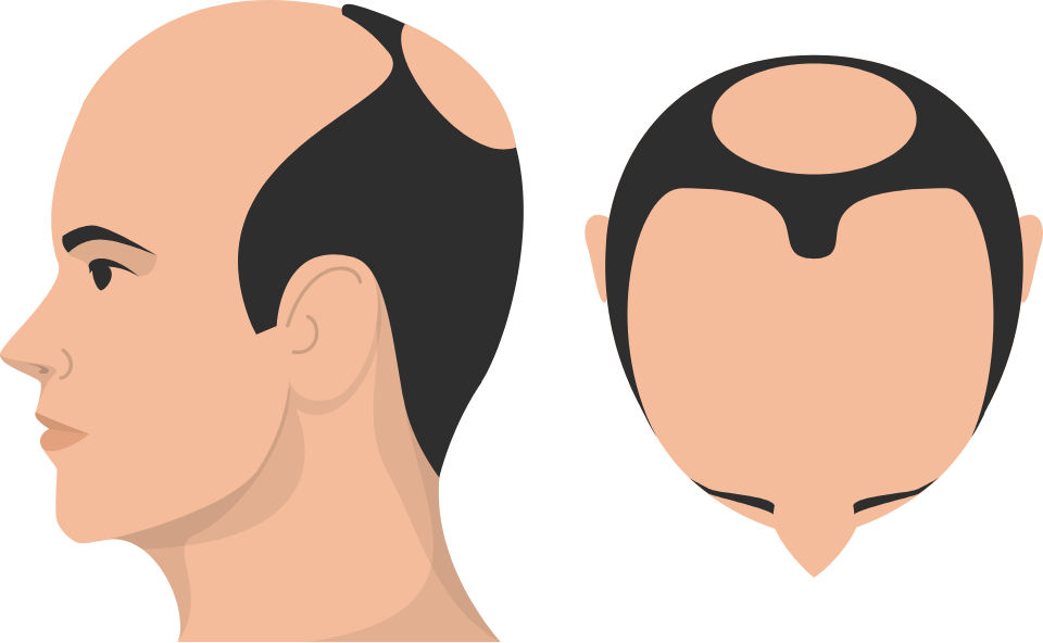 Class 7 Hair Loss graphic