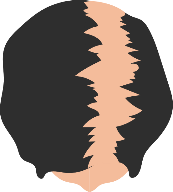 Female Pattern Hair Loss Grade 1 graphic
