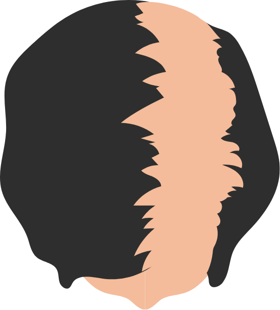 Female Pattern Hair Loss Grade 2 graphic