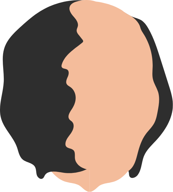 Female Pattern Hair Loss Grade 3 graphic