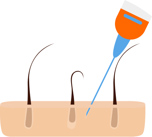PRP injection into the affected area graphic
