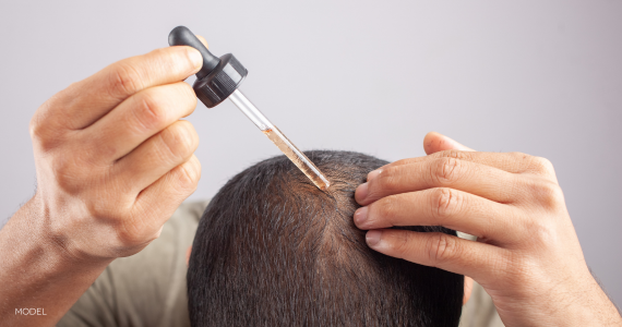 close-up of man's head, short hair, holding topical medicine in syringe to add to scalp