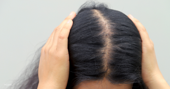 close up of thinning hair on a woman's scalp, hands placed on head on either side of part