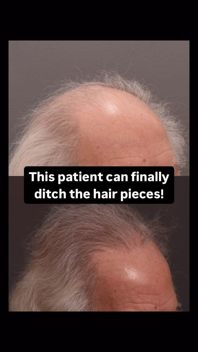 This patient had been using hair pieces since the 60s! After his first transplant he was finally ready to ditch it!

Now he is on his second transplant for added density.
There is a natural barrier to the density that can be achieved in one session. “Mega sessions” can lead to a higher fall out rate so it is possible that a patient requires more than 1 to achieve their desired density. 

First transplant: 2,156 grafts 
Second transplant: 2,161 grafts

We’ll continue to share his progress!

#hairtransplant #hairpiece #hairtransplantsurgery #hairsurgery #hairsurgeon #hairlosstreatment