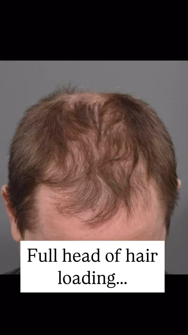 Check out the results of this 2,300 graft hair transplant! 

This patient was bothered by his balding crown and thinning central hairline. He opted for the FUT (follicular unit transplant) technique, which is perfect for filling in larger areas with high-quality grafts. 

The transformation speaks for itself!

Technique: FUT (strip method) 
Surgeon: Dr. Vito Quatela 

Ready to take the next step? Schedule your consultation today!

#hairtransplantsurgery #hairrestoration #hairsurgery #hairtransplantation #thinninghair #hairlosstreatment