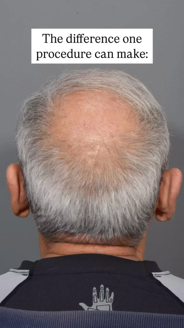 Struggling with hair loss at your crown? You’re not alone! 

This patient came to Dr. Quatela for a life-changing hair transplant, getting 2,000 grafts transplanted – and the results are unbelievable! 

If you’ve been thinking about hair restoration, this is your sign to call us and schedule your consultation!

#hairtransplantsurgery #hairtransplant #hairsurgery #hairrestoration #hairlosstreatment #hairtransplantation #baldinghair