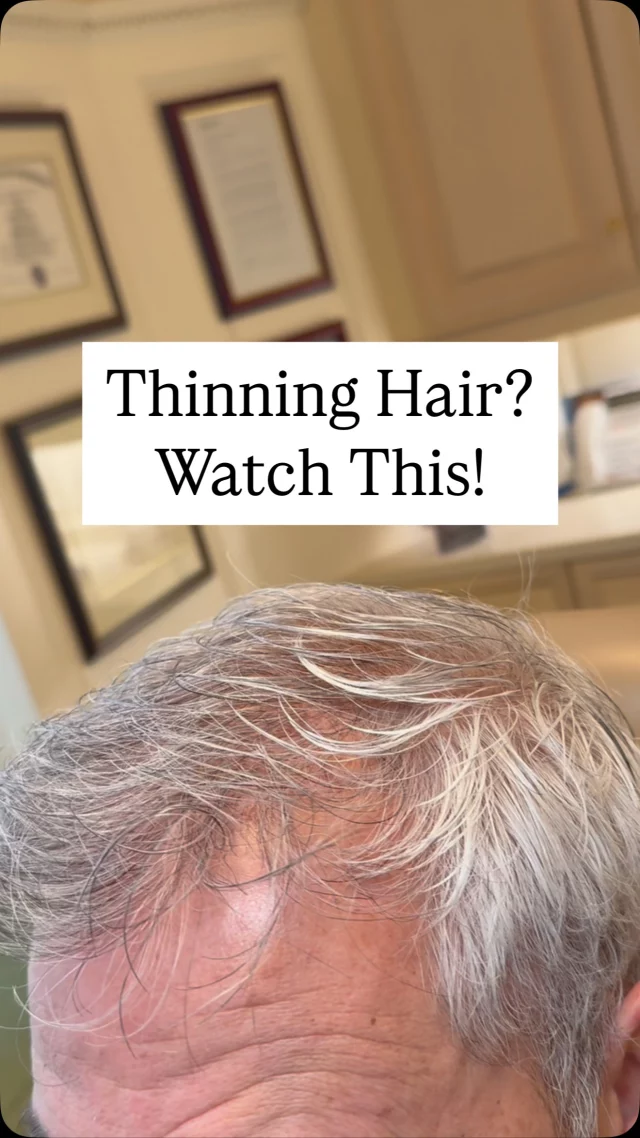 With 2,500 grafts from an FUT (Follicular Unit Transplant) hair transplant, we’ve successfully restored his frontal hairline, giving him a fuller, more natural look.

Thanks to the expertise of @dralexmontague and our incredible hair team, his hair has thickened and filled in beautifully.

Considering hair restoration? Give us a call today!

#hairtransplantsurgery #hairtransplant #hairrestoration #hairsurgery #thinninghair #baldinghair