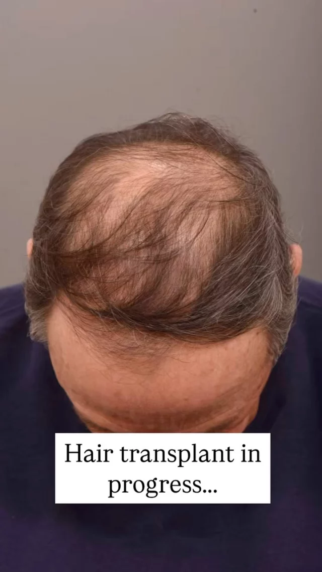 Dealing with hair loss? This procedure could change your life!

This patient had 1800 grafts transplanted using the FUE method—no visible scars, just natural-looking results ahead. Each graft is placed with precision to ensure it blends perfectly with your existing hair.

Noticeable improvements in just 6 months, and full results in 1 year. Stay tuned for his transformation!

Surgeon: World-Renowned, Double Board-Certified Facial Plastic Surgeon, Dr. Vito Quatela 

#hairtransplantsurgery #hairtransplant #hairsurgery #hairlosstreatment #thinninghair #baldinghair