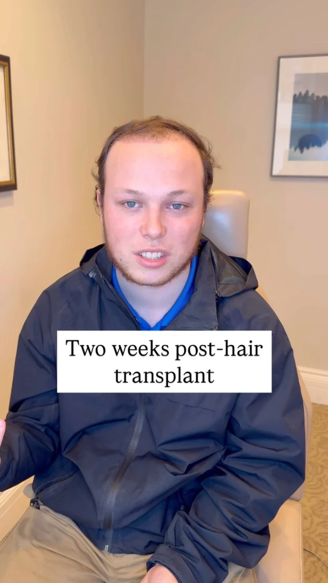 Two weeks post-FUT hair transplant with 2,700 grafts, this patient shares his experience so far. 

He began losing his hair just two years after high school and was ready for a change.

While noticeable results won’t be visible until about 5 months, he’s looking forward to the transformation ahead!

#hairtransplantsurgery #hairtransplant #hairrestoration #hairsurgery #hairjourney