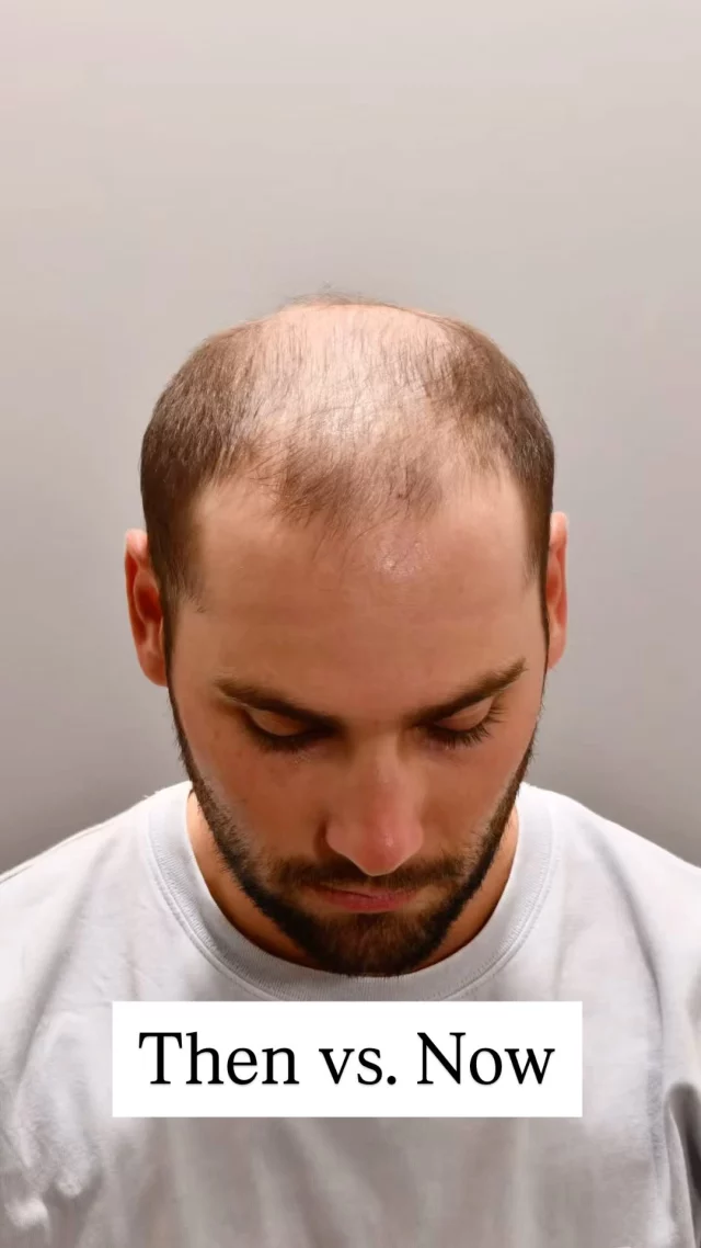 Check out this patient’s incredible transformation—just 5 months after a hair transplant using the scarless FUE technique.

The results are already amazing, and it’s only going to keep getting better from here! 

Grafts: 2,000 
Technique: Scarless/FUE
Surgeon: @dralexmontague 

#hairtransplantsurgery #hairtransplant #hairrestoration #hairsurgery #hairlosstreatment #hairtransplantation #baldinghair