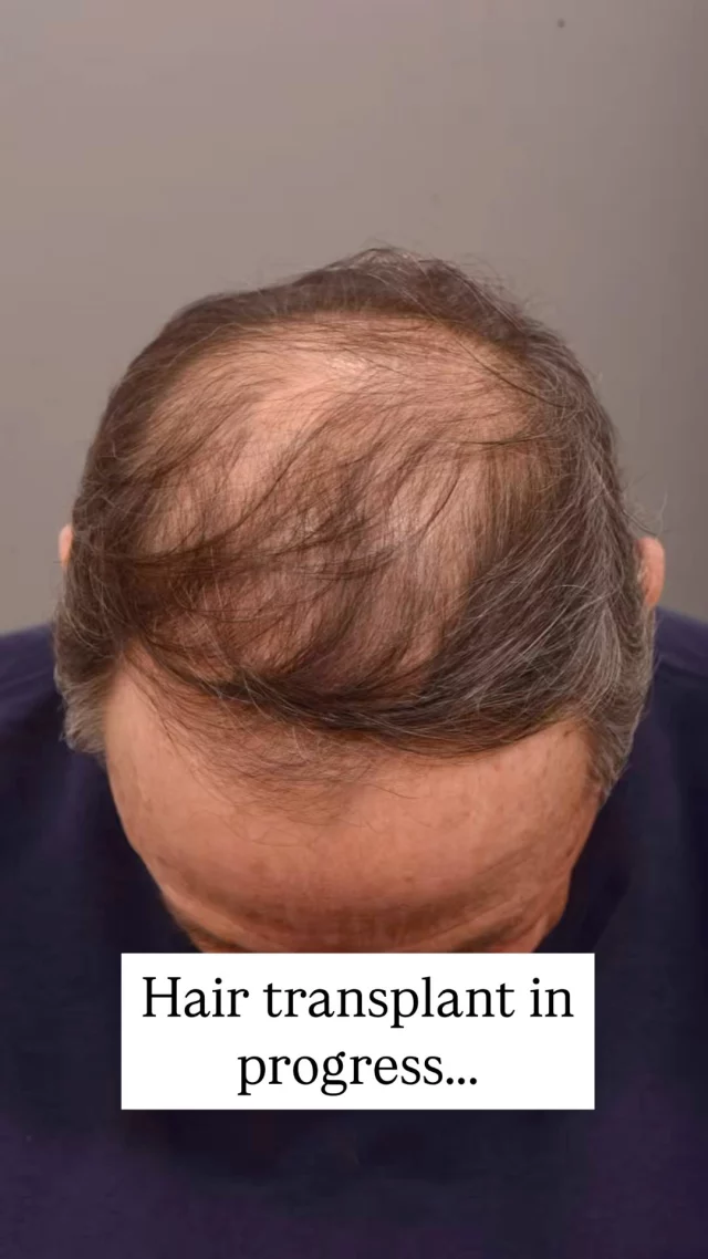 Dealing with hair loss? This procedure could change your life!

This patient had 1800 grafts transplanted using the FUE method—no visible scars, just natural-looking results ahead. Each graft is placed with precision to ensure it blends perfectly with your existing hair.

Noticeable improvements in just 6 months, and full results in 1 year. Stay tuned for his transformation!

Surgeon: World-Renowned, Double Board-Certified Facial Plastic Surgeon, Dr. Vito Quatela 

#hairtransplantsurgery #hairtransplant #hairsurgery #hairlosstreatment #thinninghair #baldinghair