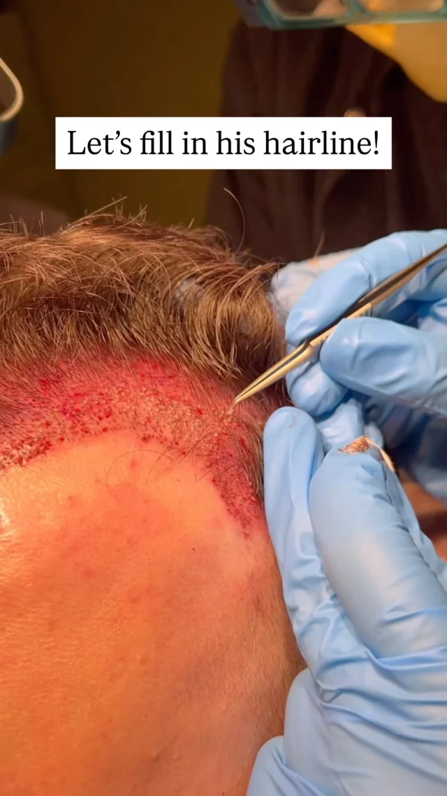 Excited to share this patients hair restoration journey! 

We’re restoring the frontal hairline, temporal recession, and addressing thinning in the back with an FUE procedure. 

This patient already has great hair – just a bit of thinning which began 5 years ago, which is completely normal. 

The right mix of restoration and medical management can make a world of difference! Can’t wait to see the final results.

#hairtransplantsurgery #hairtransplant #hairrestoration #hairrestoration #hairlosstreatment