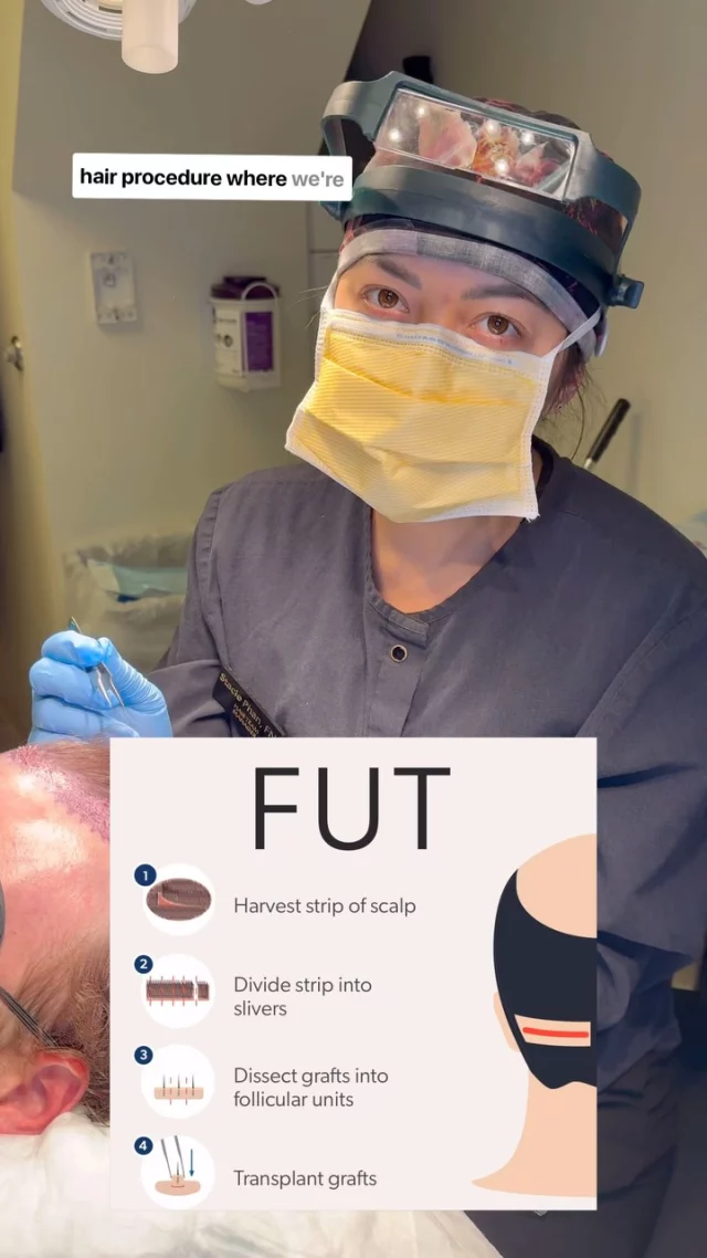 FUT transplant in action with Stacie! As the only certified trichologist in the area, Stacie works alongside our world-renowned surgeons on every transplant to ensure optimal results.

While FUT leaves a thin linear scar and requires a bit more recovery time, it’s perfect for patients with longer hair who want to fill in larger areas. 

This patient, who was unhappy with temporal recession, is well on his way to a fuller hairline!

Surgeon: World-Renowned, Double Board-Certified Facial Plastic Surgeon, Dr. Vito Quatela 
Grafts: 2200

#hairtransplantsurgery #hairtransplant #hairrestoration #hairsurgery #hairtransplantation