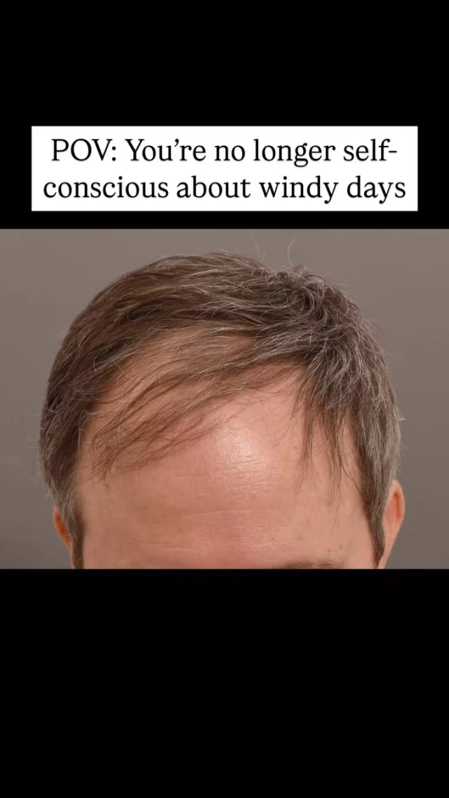 Tired of the daily comb-over struggle, this patient chose to get a hair transplant with @drheatherlee 

Opting for the FUT (strip) method, 2,600 grafts were successfully transplanted. 

Now, over 1 year post-transplant, his results are amazing, and he’ll never have to worry about the wind blowing his comb-over away again!

#hairtransplantsurgery #hairtransplant #hairrestoration #hairsurgery #hairlosstreatment #hairtransplantation #baldinghair