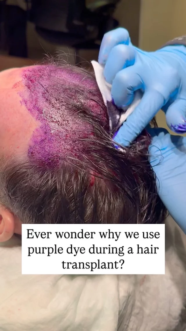 The purple dye helps to map out the hairline and graft placement during the procedure. 

It also assists in ensuring precision during the transplant process. This temporary dye fades away after a few days, leaving your new, fuller hairline behind! 

#hairtransplantsurgery #hairtransplant #hairtransplantation #hairtransplantcenter #hairtransplantclinic