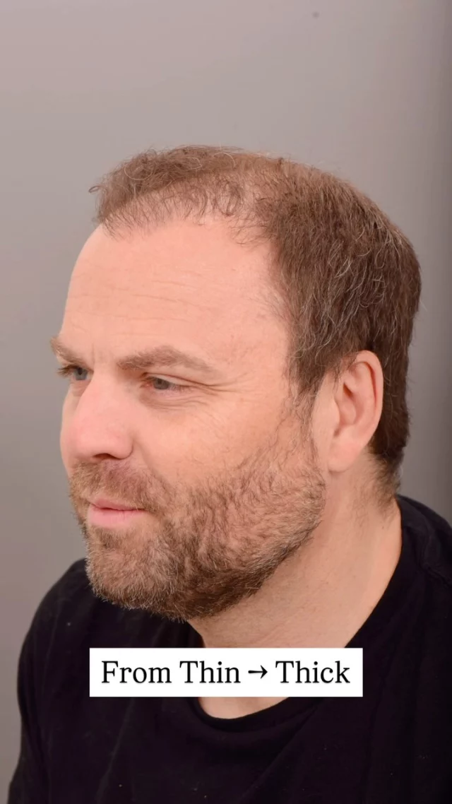A year post-hair transplant surgery with Dr. Quatela and the transformation is unreal! 

Notice how his hairline isn’t harsh or straight across – that’s because we use single hair grafts at the front to create a natural, soft transition. We also incorporate subtle irregularities in the design, ensuring it blends seamlessly with the rest of the hair for a more natural look.

Grafts: 1,900

Ready to restore your hairline? Contact us today!

#hairtransplantsurgery #hairtransplant #hairrestoration #hairsurgery #hairlosstreatment #hairtransplantation
