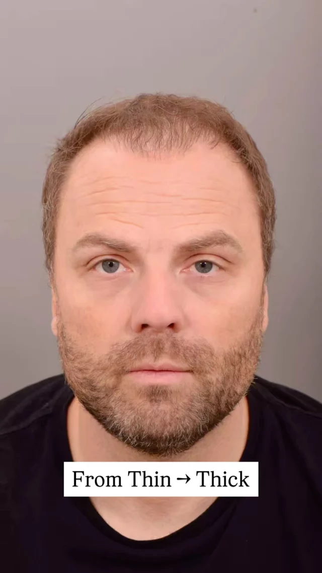 A year post-hair transplant surgery with Dr. Quatela and the transformation is unreal! 

Notice how his hairline isn’t harsh or straight across – that’s because we use single hair grafts at the front to create a natural, soft transition. We also incorporate subtle irregularities in the design, ensuring it blends seamlessly with the rest of the hair for a more natural look.

Ready to restore your hairline? Contact us today!

#hairtransplantsurgery #hairtransplant #hairrestoration #hairsurgery #hairlosstreatment #hairtransplantation
