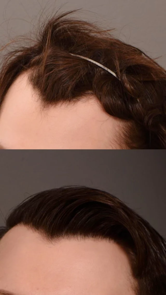 This patient had a great head of hair to start - but his naturally mature hairline and strong widow’s peak gave him a more aged appearance than he wanted.

He came to us to soften and refine his hairline, and after 1,600 grafts and one year of growth, his results are everything he hoped for!

Surgeon: @drheatherlee 

#hairtransplantsurgery #hairtransplant #hairrestoration #hairlosstreatment #hairtransplantation #thinninghair