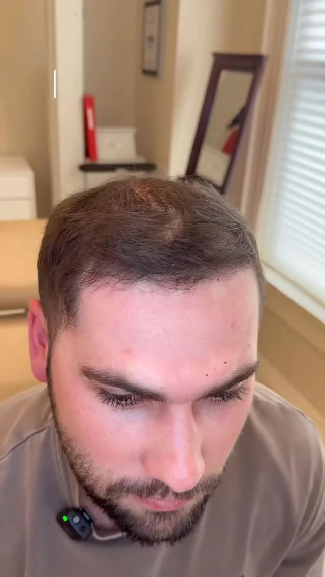 If you’re considering a hair transplant, watch this 5-month update from one of our FUE transplant patients. 

With 2,000 grafts transplanted, he’s already seeing amazing results that will only continue to improve as we approach the one-year mark!

The procedure may be long, but it’s virtually painless, and recovery is quick. 

Call us today to schedule your consultation!

#hairtransplantresults #hairtransplantresult #hairtransplant #hairrestoration #hairtransplantsurgery