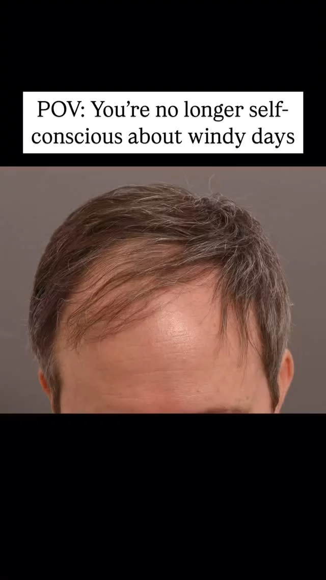 Tired of the daily comb-over struggle, this patient chose to get a hair transplant with @drheatherlee 

Opting for the FUT (strip) method, 2,600 grafts were successfully transplanted. 

Now, over 1 year post-transplant, his results are amazing, and he’ll never have to worry about the wind blowing his comb-over away again!

#hairtransplantsurgery #hairtransplant #hairrestoration #hairsurgery #hairlosstreatment #hairtransplantation #baldinghair
