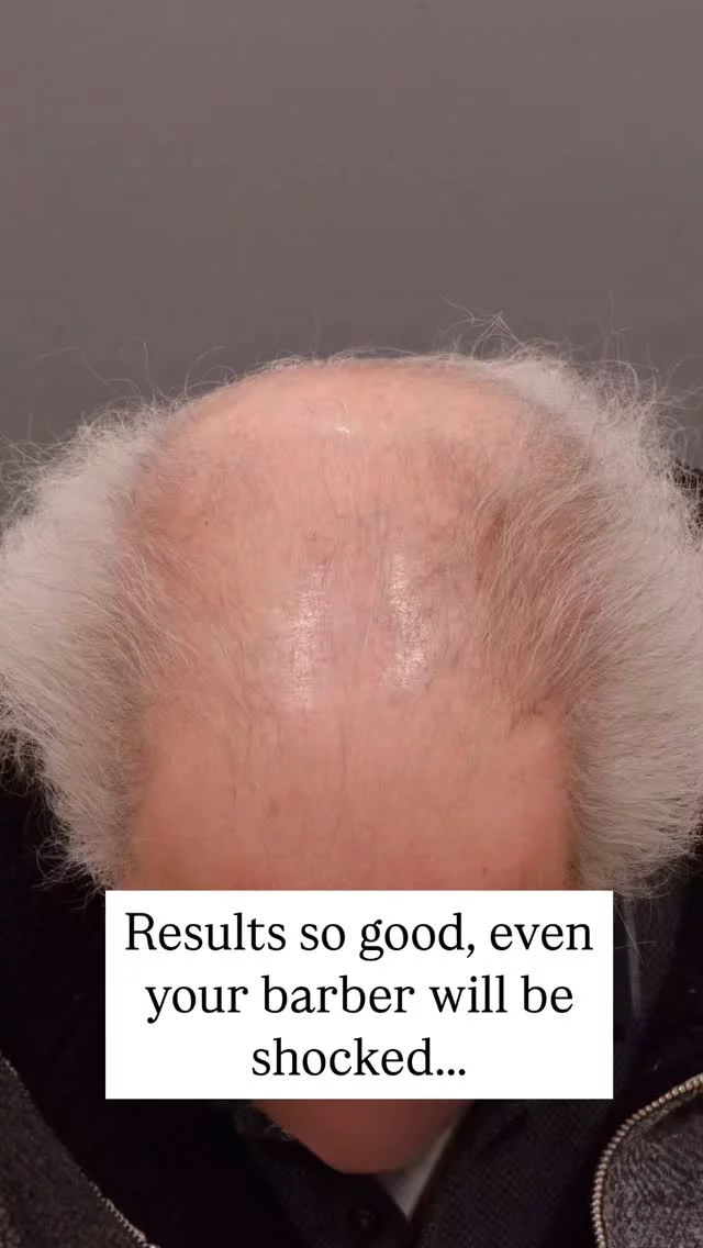 40 years of hair loss, but it’s never too late for a change! 

One year after his second hair transplant with Dr. Vito Quatela, this patient is seeing life-changing results! 

Our doctors always explain that multiple transplants may be needed for the best results, as graft placement is limited to avoid overcrowding. Often, a second transplant can help improve and perfect the final result.

First transplant: 2,200 grafts
Second transplant: 2,200 grafts
Technique: FUT

#hairtransplantsurgery #hairrestoration #hairsurgery #hairlosstreatment #hairtransplantation #hairloss #baldnesssolution