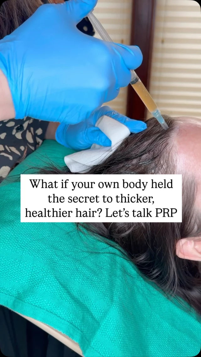 Struggling with thinning hair? PRP therapy uses your own blood to stimulate hair growth and improve scalp health. 

By isolating platelets and injecting them into thinning areas, we activate hair follicles for thicker, healthier hair. 

No downtime, and you can resume exercise the day after treatment. Noticeable results in 3 months, full results 6-12 months after your last treatment.

Book a consultation today! 

#PRPTherapy #HairRestoration #HairGrowth #ScalpHealth