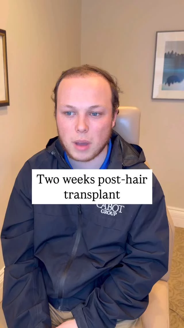 Two weeks post-FUT hair transplant with 2,700 grafts, this patient shares his experience so far. 

He began losing his hair just two years after high school and was ready for a change.

While noticeable won’t be visible until about 5 months, he’s looking forward to the transformation ahead!

#hairtransplantsurgery #hairtransplant #hairrestoration #hairsurgery #hairjourney