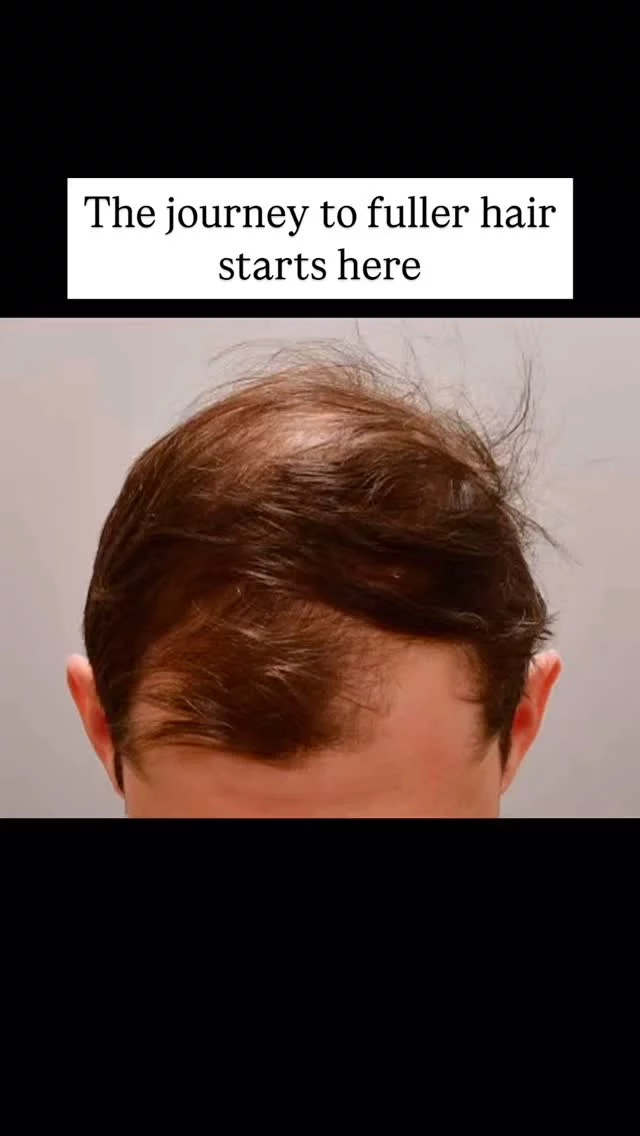 Did you know an FUE hair transplant is a minimally invasive procedure that can restore your hair?

This patient came to us with thinning in his frontal hairline and crown. We transplanted 1,900 grafts, and although he’s only 2 weeks post-transplant, we’re excited for what’s to come!

Full results can take up to a year, but the transformation is totally worth the wait! Stay tuned!

Grafts: 1,900 
Surgeon: @dralexmontague 

#hairtransplantsurgery #hairtransplant #hairrestoration #hairsurgery #hairlosstreatment #hairtransplantation #hairloss #thinninghair
