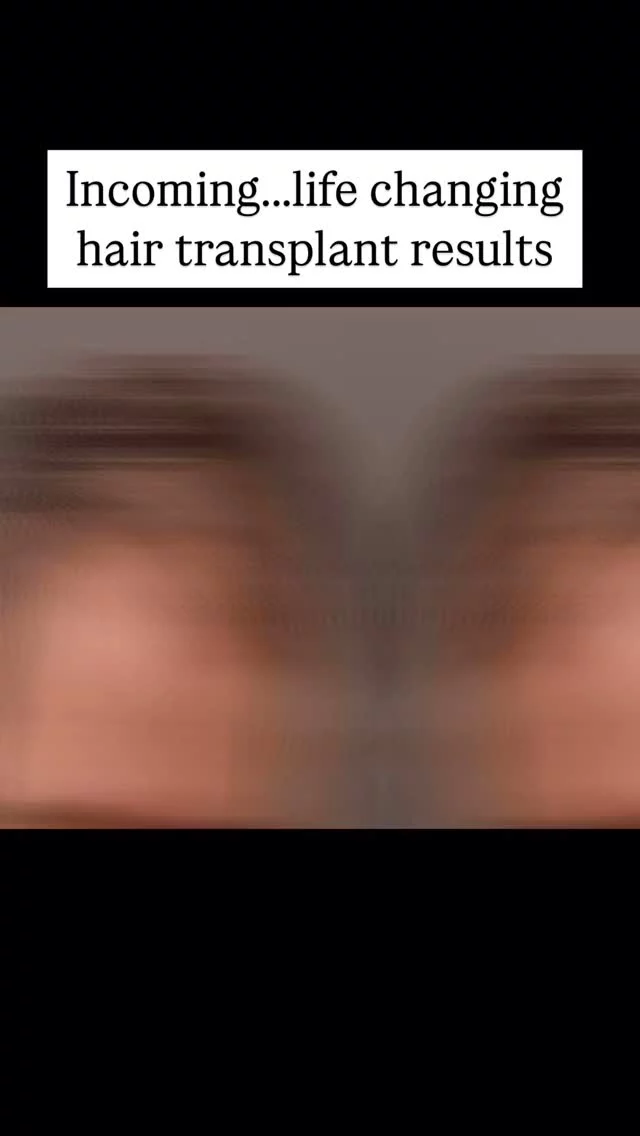 From thinning to a full head of hair! 

1-year transformation after getting a FUT hair transplant with Dr. Lee. 2600 grafts, a bit of patience, and a whole lot of confidence later-check out his journey.

→ Before Surgery: Thinning hair, ready for a change.
→ 2 weeks in: Healing well, scabs are gone, shedding starts–growth is coming.
→ 5 months later: New growth filling in and looking fuller already!
→ 1 year later: Full, natural hair and a huge confidence boost!

Trust the process!

#hairtransplantsurgery #hairtransplant #hairrestoration #hairsurgery #hairlosstreatment #hairtransplantation
