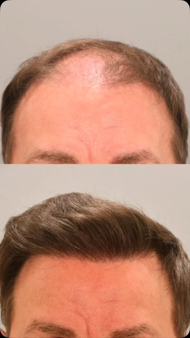 Real patients. Real results. Real growth. 

From FUE & FUT transplants to PRP and medical management – we offer customized solutions for every stage of hair loss.

At the Quatela Center, you’ll meet with our double board-certified facial plastic surgeons to create a personalized plan and determine the best options for you. This is hair restoration, done right.

#hairtransplantsurgery #hairtransplant #hairrestoration #hairsurgery #hairlosstreatment #hairtransplantation