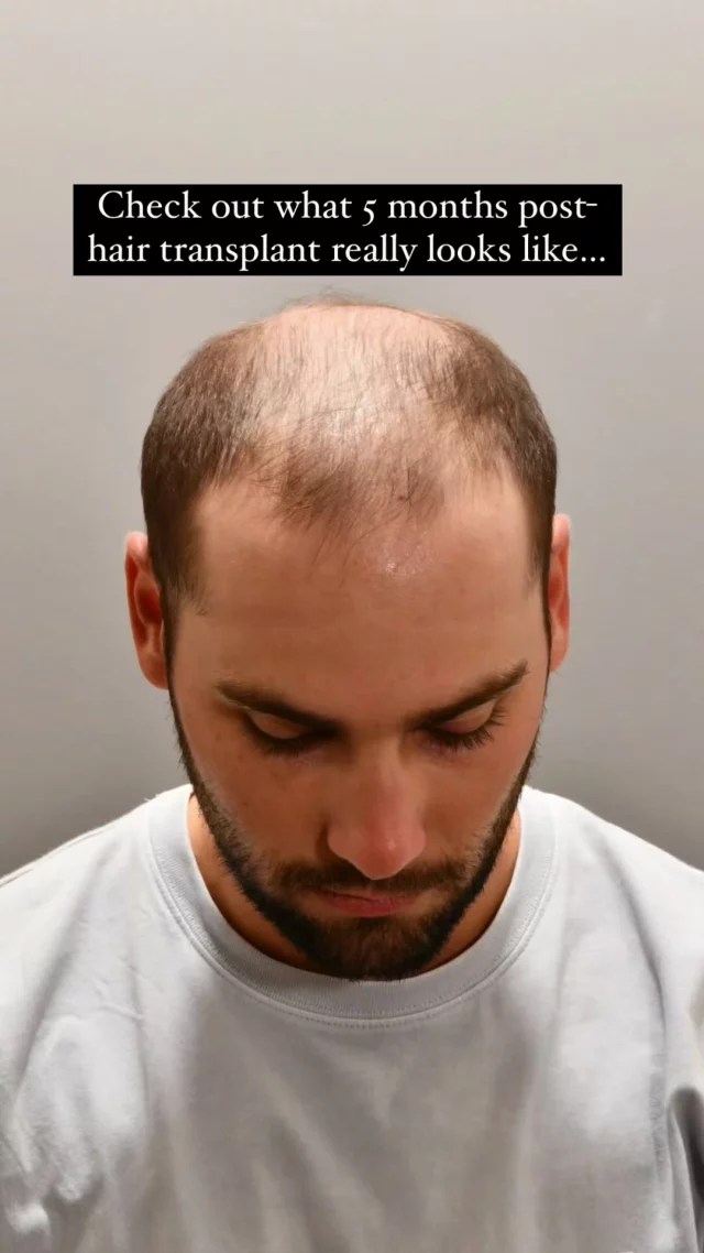And it’s only going to get better from here! 

5 months post-transplant and look at these results already! The transformation is just getting started – stay tuned for the full reveal at the 1-year mark.

Technique: Scarless/FUE
Grafts: 2,000
Surgeon: @dralexmontague 

#hairtransplantsurgery #hairtransplant #hairsurgery #hairtransplantation #hairsurgeon #hairloss #baldinghair #thinninghair