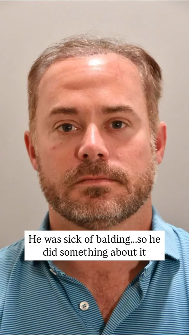 Ever wonder what a hair transplant + PRP can really do? Check this out!

After 2 years of thinning at the hairline, this patient’s FUT transplant + maintenance PRP treatments gave him a full, thick hairline and a serious confidence boost.

Over a year later, the results speak for themselves!

Grafts: 1,900
Surgeon: World-Renowned, Double Board-Certified Facial Plastic Surgeon, Dr. Vito Quatela

#hairtransplantsurgery #hairtransplant #prp #prptreatment #hairlosstreatment #hairrestoration