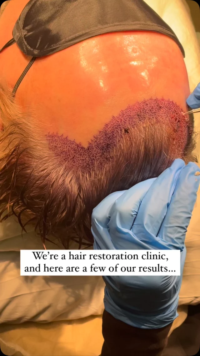 Real patients. Real results. Real growth. 

From FUE & FUT transplants to PRP and medical management – we offer customized solutions for every stage of hair loss.

At the Quatela Center, you’ll meet with our double board-certified facial plastic surgeons to create a personalized plan and determine the best options for you. This is hair restoration, done right.

#hairtransplantsurgery #hairtransplant #hairrestoration #hairsurgery #hairlosstreatment #hairtransplantation