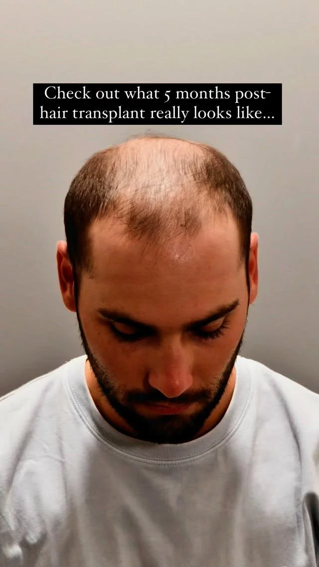 And it’s only going to get better from here! 

5 months post-transplant and look at these results already! The transformation is just getting started – stay tuned for the full reveal at the 1-year mark.

Technique: Scarless/FUE
Grafts: 2,000

#hairtransplantsurgery #hairtransplant #hairsurgery #hairtransplantation #hairsurgeon #hairloss #baldinghair #thinninghair